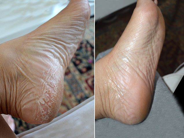 Baby Foot Exfoliation Foot Peel (Lavender)